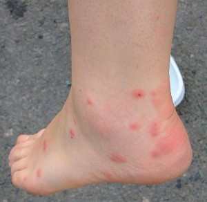 bed bug bites 300x292