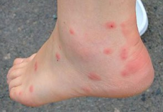 Red, itchy bug bites on an ankle.