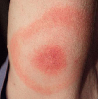 A bullseye rash on a person's arm.